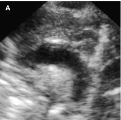 Gambar 8. Gambaran ekokardiografi yang menunjukkan aorta di sisi kiri.1 