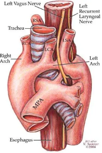 Gambar 11. Barium esofagografi pada double aortic arch.1 