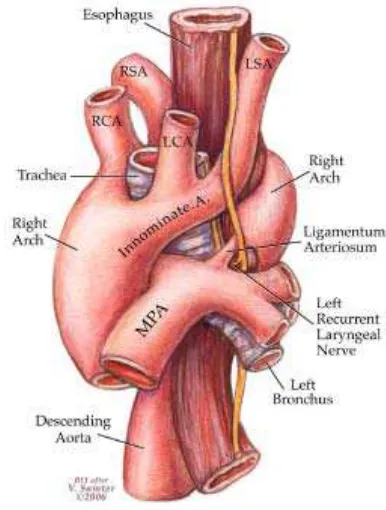 Gambar 12. Arkus aorta kanan dengan 