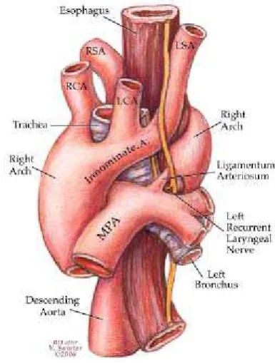 Gambar 12. Arkus aorta kanan dengan 