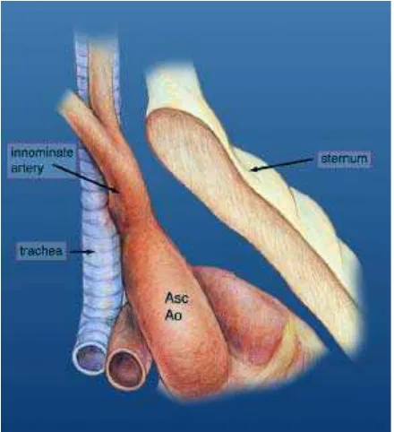 Gambar 14. Arkus aorta kanan, duktus kiri dari divertikulum Kommerell.1 