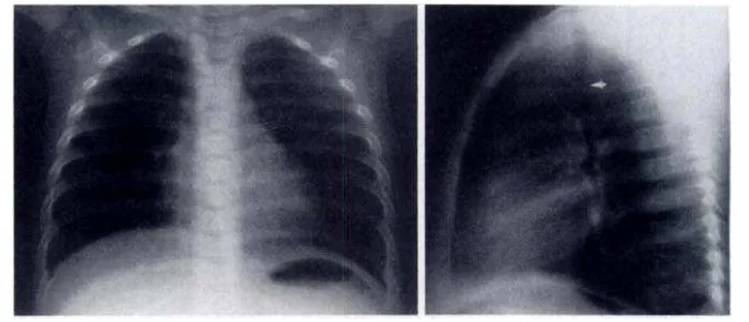 Gambar 5. Radiografi anteroposterior dan lateral.3 