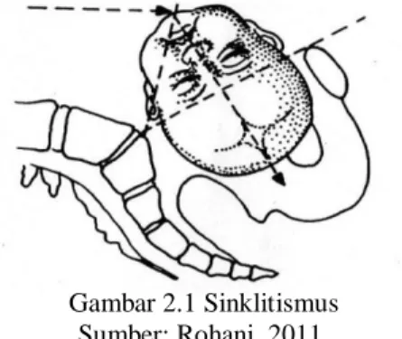 Gambar 2.1 Sinklitismus  Sumber: Rohani, 2011. 