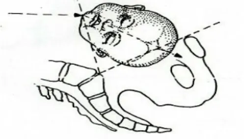 Gambar 2.3 Asinklitismus Anterior 