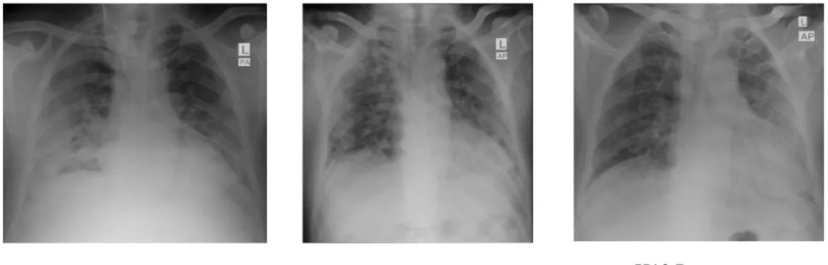 Gambar 1. Ronsen toraks pasien dan perkembangannya  Ronsen dada  (gambar 1.) 