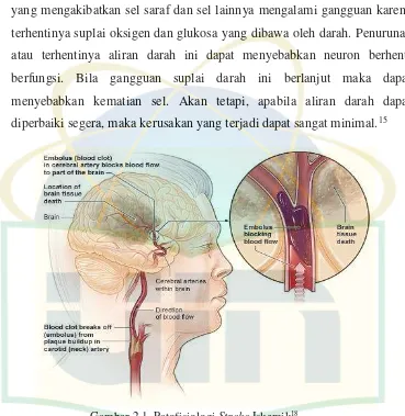 Gambar 2.1. Patofisiologi  Stroke Iskemik18 Sumber : National Heart, Lung, and Blood Institute, 2014 