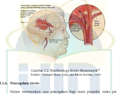 Gambar 2.2. Patofisiologi Stroke Hemorargik18 