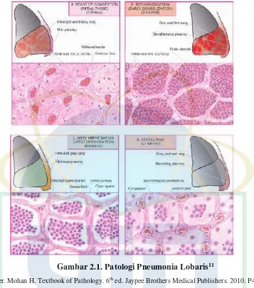 Gambar 2.2. Gambaran Histologi Patologi Pneumonia Lobaris11