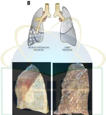 Gambar 2.5. Perbedaan Penampakan antara Pneumonia Lobaris dan