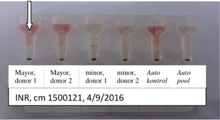 Gambar 2.7 Hasil pemeriksaan crossmatch dengan metode gel menunjukan hasil  kompatibel dengan warna kemerahan pada permukaan gel.