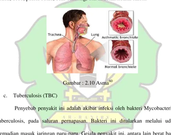 Gambar : 2.10 Asma 60 c.  Tuberculosis (TBC) 