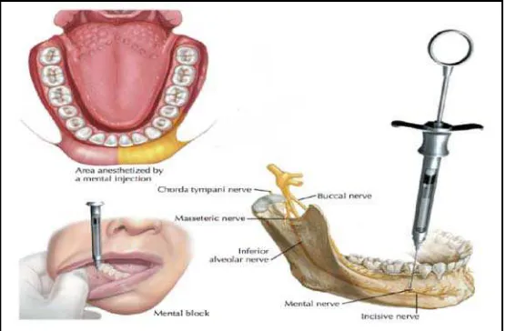Gambar 2. Ilustrasi mental nerve block.16 