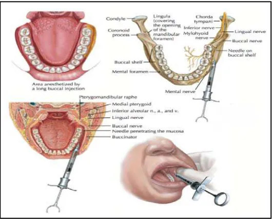 Gambar 3. Ilustrasi buccal nerve block.16 