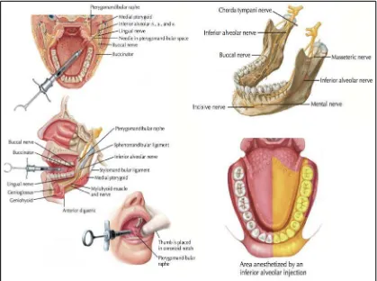 Gambar 4. Ilustrasi Inferior Alveolar Nervus Block.16 