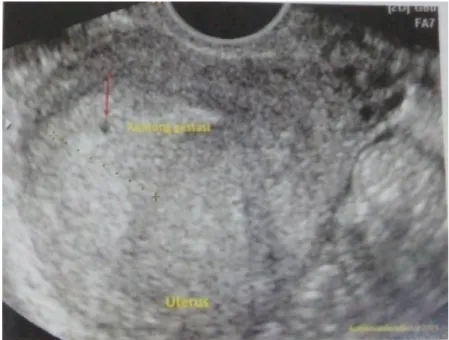Gambar  2.1  Kantong  gestasi  normal  pada  kehamilan  intrauterine 4 minggu (lihat tanda panah berwarna merah) 