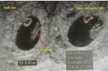 Gambar 2.3 Pengukuran CRL, tampak CRL 8,9 mm sesuai  kehamilan  6  minggu  6  hari  (juga  tampak  YS  normal,  berdiameter 4,7 mm) 