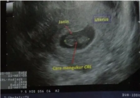 Gambar 2.4 Ukuran CRL 22 mm sesuai kehamilan 8 minggu  6 hari 