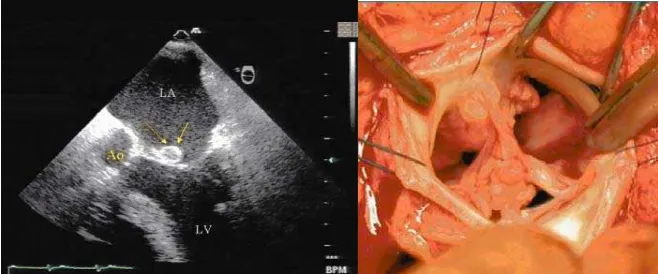 Gambar 4. Kiri: Vegetasi yang melekat pada katup mitral anterior, terdeteksi  katup aorta menggunakan ekokardiografi trans-esophageal
