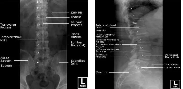 Gambar 1. Gambaran anatomi radiografik vertebra lumbalis, posisi antero-posterior dan lateral