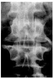 Gambar 8. Foto polos lumbosakral arah anteroposterior, tampak gambaran osteofit. Dikutip 