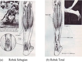 Gambar 3. Tendo Achilles Robek/Strain (dikutip dari Peterson Lars, dan Renstrom Per., 1986: 332-333) 