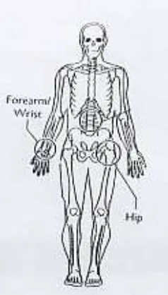 Gambar 2. Bagian osteoporosis pada paha dan lengan bawah.