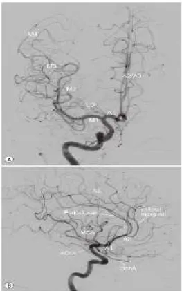 Gambar  2.  Digital  Substraction  Angiography  (DSA)  dari  ICA.  (A)  posisi  AP.  (B)  Posisi  Lateral