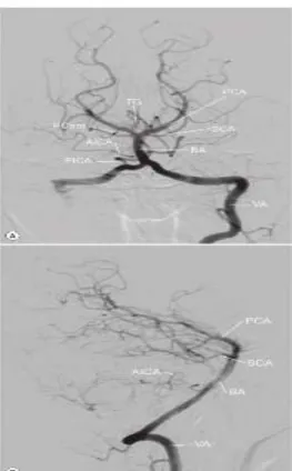 Gambar 3. DSA dari sirkulasi vertebrobasilar. (A) AP dan (B) lateral. Arteri vertebral (VA),  Arteri  basilar  (BA),  arteri  cerebellar  posterior  inferior  (PICA),  Arteri  cerebellar  anterior  inferior  (AICA),  arteri  cerebellar  superior      (SCA)
