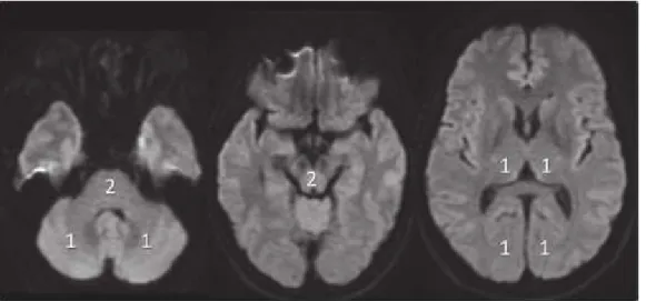 Gambar 9. pcASPECT. Kedua thalamus dan regio occipital berhubungan dengan teritoriti  PCA diberikan nilai masing-masing 1