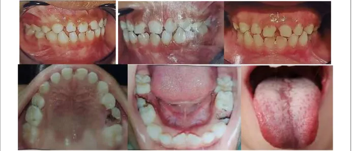 Gambar 1. Gambar klinis rongga mulut anak 