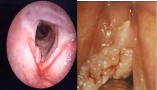 Gambar 1. Karsinoma Laring 