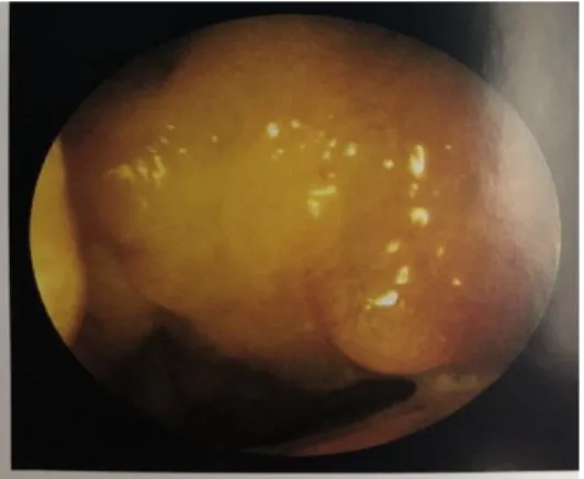 Gambar 4. Adenoid 