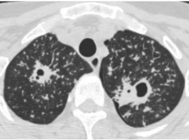 Gambar 7. Parenchymal postprimary tuberculosis. High-resolution CT  scan shows the typical apical cavitation of postprimary tuberculosis