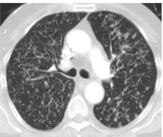 Gambar 8. Parenchymal postprimary tuberculosis. High-resolution CT  scan demonstrates multiple small, centrilobular nodules connected to 