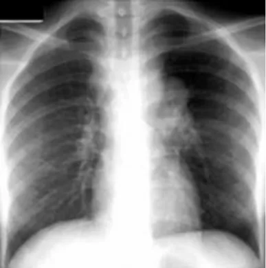 Gambar 7. Pasien limfadenopati pada pasien tuberculosis. Gambar menunjukan hilus kiri dan massa pada paratrakeal kanan dengan limfadenopati dan tipical pada pasien pediatric