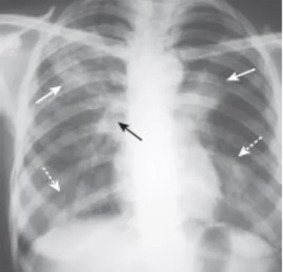 Gambar 9. Tuberkulosis primer. Ada menonjol dari hilus kanan (panah hitam) yang disebabkan oleh adenopati hilus