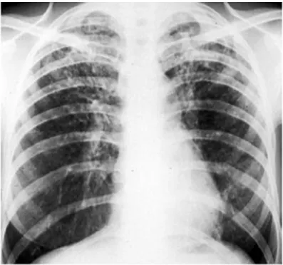 Gambar 15. Tuberculosis Post Primer. Gambar menunjukan karakteristik bilateral fibrosis pada lobus atas dengan