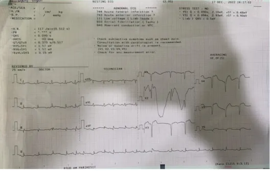 Gambar 3. 2 Pemeriksaan EKG Tanggal 17 Desember 2022 