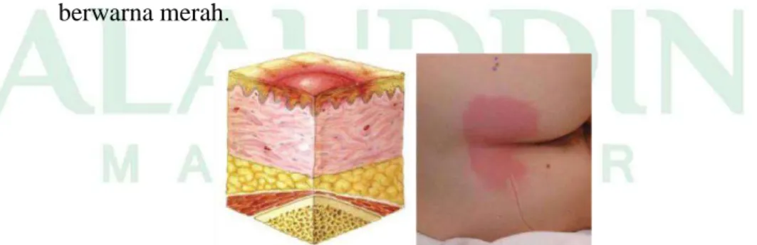 Gambar 2.1. Dekubitus derajat I (Sumber : NPUAP, 2014)   2)  Derajat II : Partial Thickness Skin Loss  