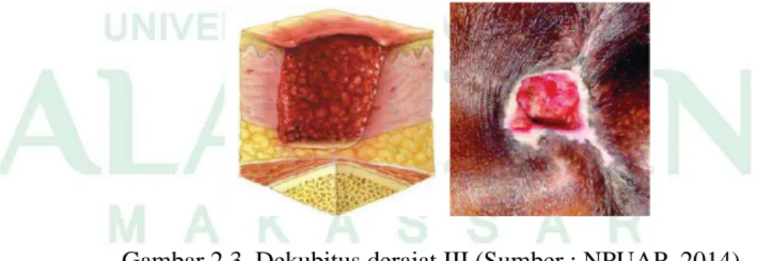 Gambar 2.3. Dekubitus derajat III (Sumber : NPUAP, 2014)  4)  Derajat IV : Full Thickness Tissue Loss  