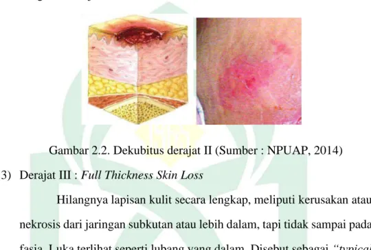 Gambar 2.2. Dekubitus derajat II (Sumber : NPUAP, 2014)  3)  Derajat III : Full Thickness Skin Loss  