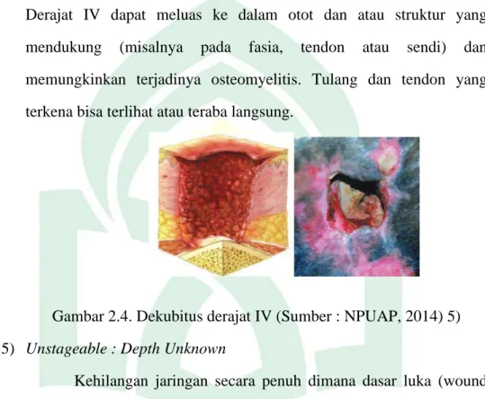 Gambar 2.4. Dekubitus derajat IV (Sumber : NPUAP, 2014) 5)  5)  Unstageable : Depth Unknown  
