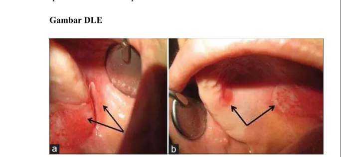 Gambar 3.1 (a) Palatal large ulcerative lesion (Lt.) radiating and extending up to the cheek mucosa