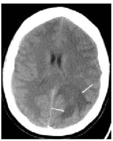 Gambar 10. CT Scan early cerebritis
