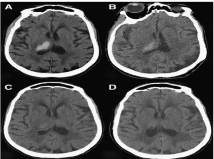 Gambar 16. Penggambaran CT pada pendarahan. Serial CT scans pada hematoma thalamus dekstra