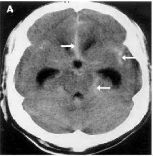 Gambar 17. Acute subaraknoid hemorrhage (SAH) akibat ruptur aneurisma di arteri komunikan anterior pada pasien laki-laki usia 40 tahun