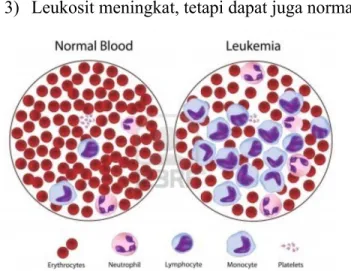 Gambar Pemeriksaan Darah Tepi pada Pasien Leukemia