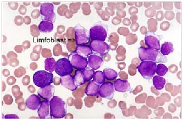 Gambar Limfoblast pada penderita Leukemia