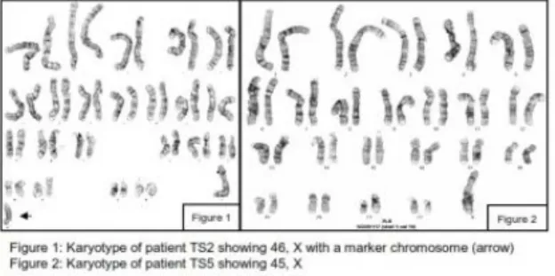 Gambar Contoh Hasil Interpretasi Pemeriksaan Sitogenik d. Pemeriksaan immunophenotyping
