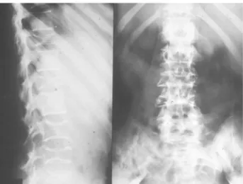 Gambar Radiologi Pasien Multiple Myeloma